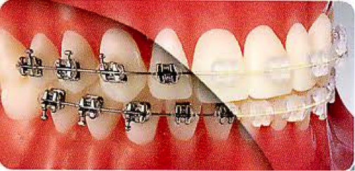 クリスタル歯列矯正例