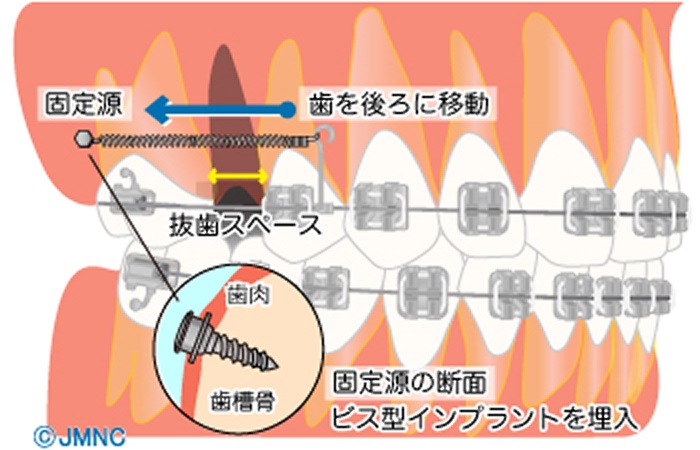 アンカースクリュー矯正のイメージ画像