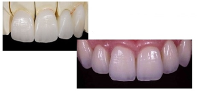 天然歯のようなオールセラミック歯