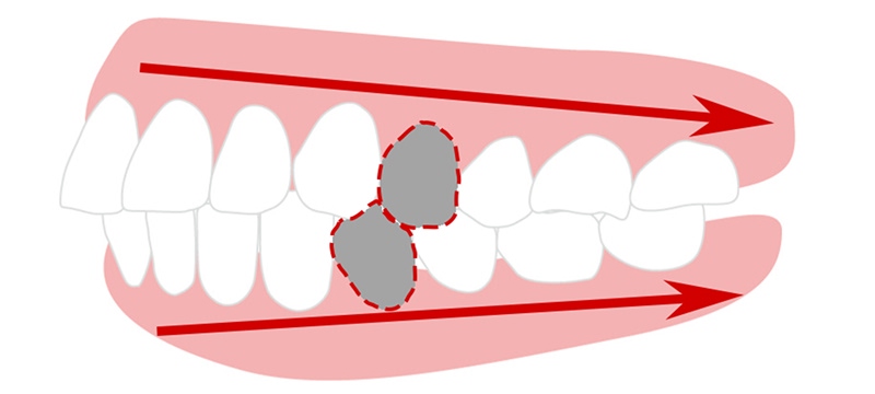 抜歯をしてスペースを作るアンカースクリュー矯正法