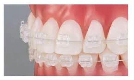 クリスタル歯列矯正例