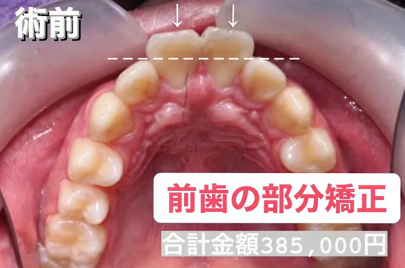 歯科矯正-ビフォーアフター症例写真（マウスピース部分矯正プラス-出っ歯・前歯の部分矯正）