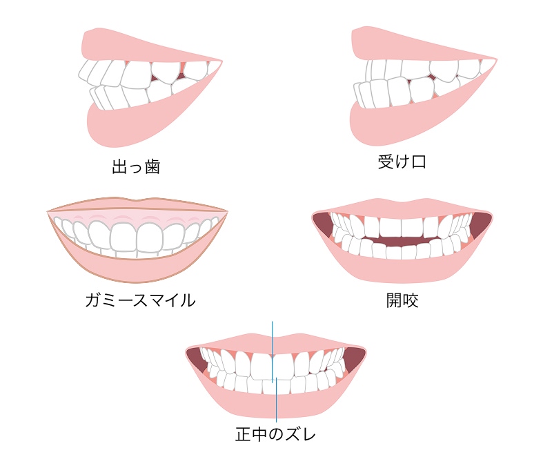 アンカースクリュー矯正の対応歯並びの画像（出っ歯・受け口・ガミースマイル・開咬・正中のズレ）