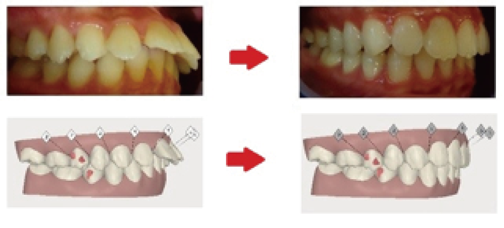 インビザライン治療例2 18歳男性