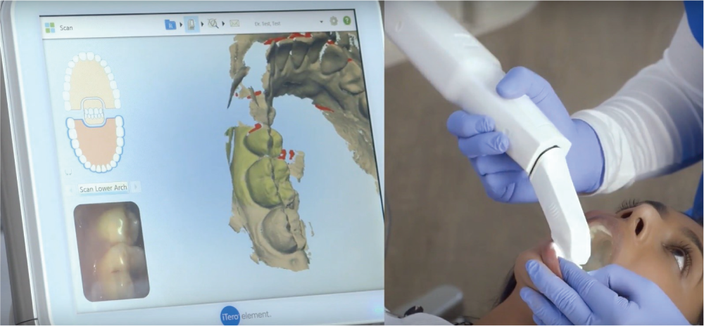 3Dデジタル歯科用光学スキャナー