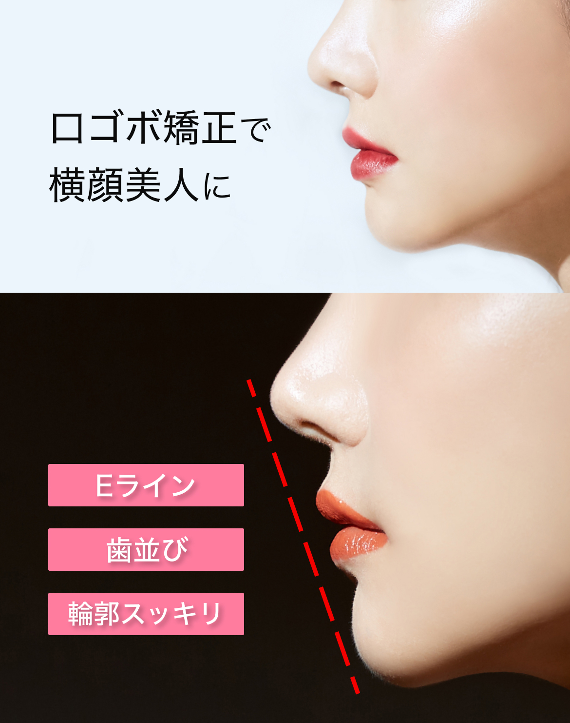 東京銀座ビアンコ矯正歯科の口ゴボ(横顔・Eライン矯正)イメージ 「口ゴボ矯正で横顔美人に Eライン・歯並び・輪郭スッキリ」