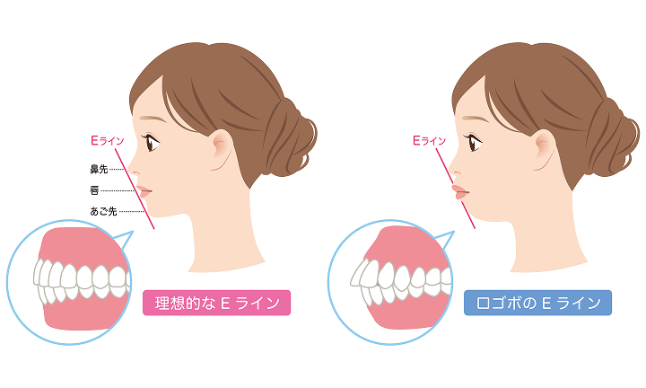 口ゴボ矯正-横顔矯正-Eライン矯正