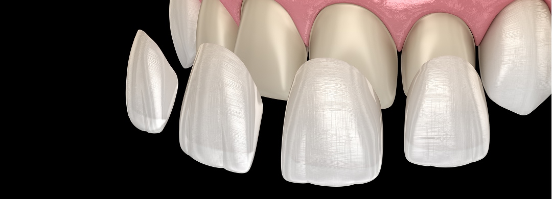 セラミック治療-削らないラミネートベニア（ゼロベニア）