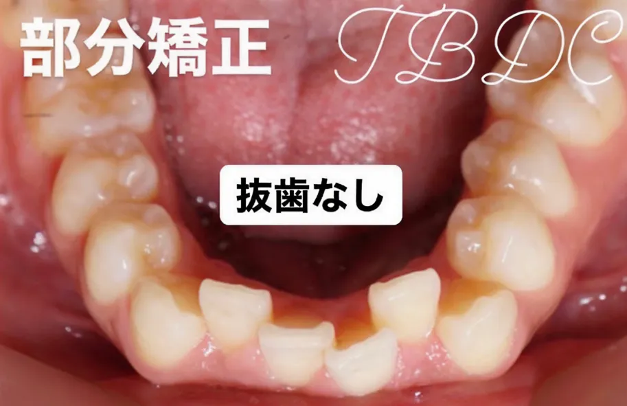歯科矯正-ビフォーアフター症例写真-矯正前-マウスピース矯正（インビザライン）-歯のガタつき