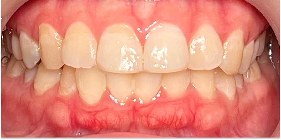 前歯のギザギザを整える症例写真（治療後）