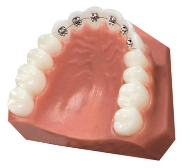 前歯だけの部分歯列矯正イメージ
