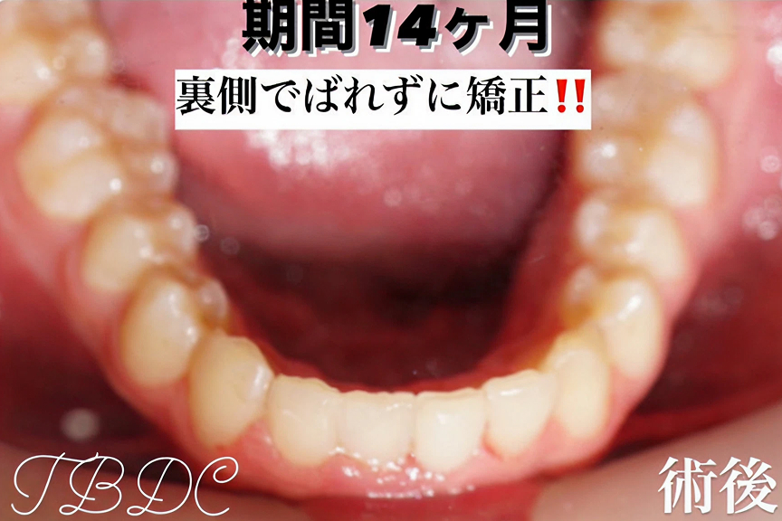 歯科矯正-ビフォーアフター症例写真-矯正後-コラボ矯正(マウスピース矯正×ワイヤー)-歯のガタつき