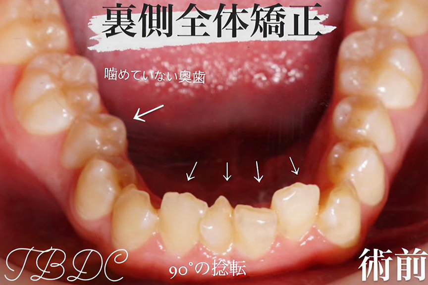 歯科矯正-ビフォーアフター症例写真-矯正前-コラボ矯正(マウスピース矯正×ワイヤー)-歯のガタつき